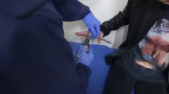 Extracción de anillo
